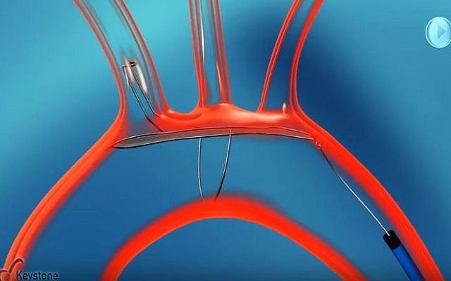 An illustration of how the TriGUARD 3 device, developed by Caesarea, Israel-based firm Keystone Heart Ltd. works (YouTube screenshot) An illustration of how the TriGUARD 3 device, developed by Caesarea, Israel-based firm Keystone Heart Ltd. works (YouTube screenshot)