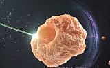 Israeli firm Lumenis' Moses technology is considered a 'gamechanger' in the treatment of urinary stones (YouTube Screenshot)