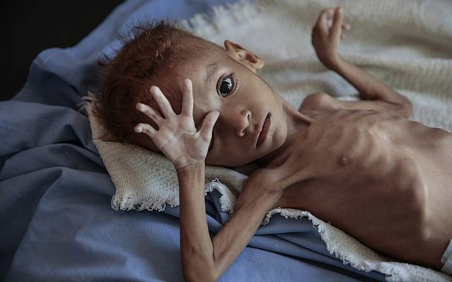 In this Oct. 1, 2018, file, photo, a severely malnourished boy rests on a hospital bed at the Aslam Health Center, Hajjah, Yemen (AP Photo/Hani Mohammed, File) In this Oct. 1, 2018, file, photo, a severely malnourished boy rests on a hospital bed at the Aslam Health Center, Hajjah, Yemen (AP Photo/Hani Mohammed, File)