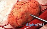 An illustration of how a needle containing alpha particles is inserted into a solid tumor; Alpha Tau Medical says it has developed a technology in which these alpha particles can live long enough to destroy the cells (Courtesy)