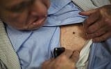 ILLUSTRATIVE -- In this photo taken Aug. 27, 2015, John Jay Hooker shows a melanoma spot that has shrunk since starting treatment at Tennessee Oncology in Nashville, Tennessee (AP Photo/David Goldman)