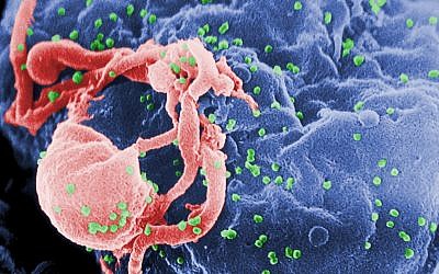 This undated photo provided by the Centers for Disease Control and Prevention shows a scanning electron micrograph of multiple round bumps of the HIV-1 virus on a cell surface (Cynthia Goldsmith/Centers for Disease Control and Prevention via AP)