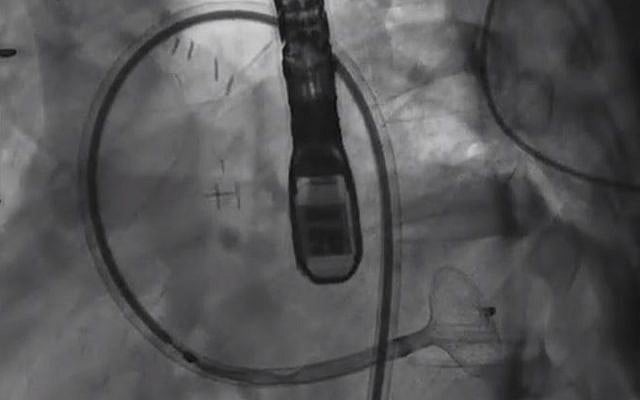 Prof. Victor Guetta, irector of the Invasive and Interventional Cardiology Unit at Sheba Medical Center, plugged a bleeding hole in the artery of a 29-year-old patient using a device that is usually used to unblock arteries (YouTube screenshot) Prof. Victor Guetta, irector of the Invasive and Interventional Cardiology Unit at Sheba Medical Center, plugged a bleeding hole in the artery of a 29-year-old patient using a device that is usually used to unblock arteries (YouTube screenshot)