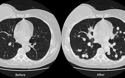 An illustration of a CT scan that was tampered with by the researchers at Ben-Gurion University of the Negev (Courtesy)