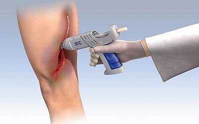 Technion researchers have developed a medical glue gun to help heal human tissue that has been seriously injured (Courtesy)