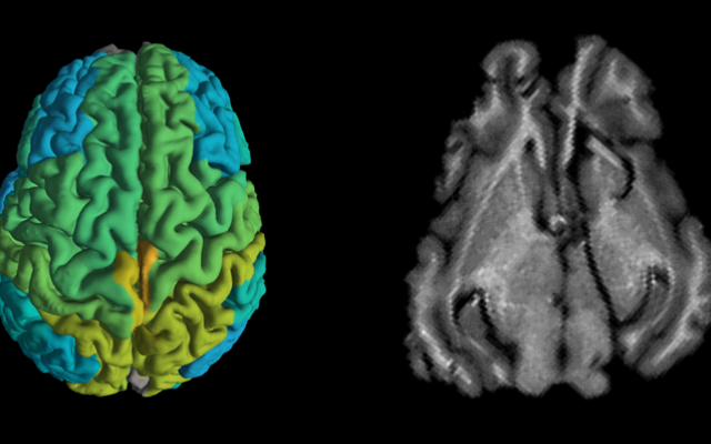 Standard MRI brain scan of a pig, right, and a new MRI scan showing differences in molecular makeup in different parts of the brain (Shir Filo/Hebrew University) Standard MRI brain scan of a pig, right, and a new MRI scan showing differences in molecular makeup in different parts of the brain (Shir Filo/Hebrew University)