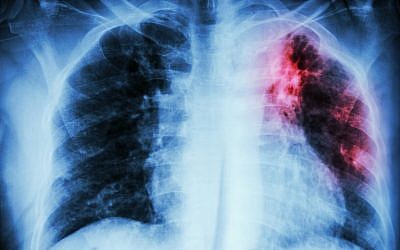 An illustrative image of a chest with pulmonary tuberculosis (stockdevil; iStock by Getty Images)