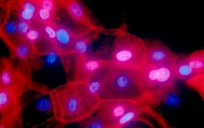 This undated fluorescence-colored microscope image made available by the National Institutes of Health in September 2016 shows a culture of human breast cancer cells. (Ewa Krawczyk/National Cancer Institute via AP) This undated fluorescence-colored microscope image made available by the National Institutes of Health in September 2016 shows a culture of human breast cancer cells. (Ewa Krawczyk/National Cancer Institute via AP)