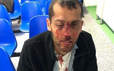 Yotam Kashpizky after being beaten in an allegedly nationalistically motivated attack in Poland on September 8, 2019. (Facebook)