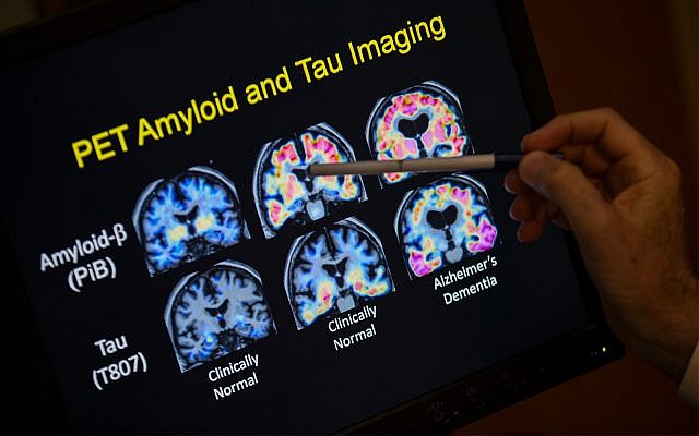 Illustrative: A researcher points to PET scan results that are part of a study on Alzheimer's disease at Georgetown University Hospital, May 19, 2015, in Washington. (AP Photo/Evan Vucci) Illustrative: A researcher points to PET scan results that are part of a study on Alzheimer's disease at Georgetown University Hospital, May 19, 2015, in Washington. (AP Photo/Evan Vucci)
