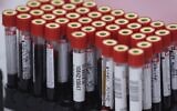 Illustrative: Blood samples (AP Photo/Martin Mejia)