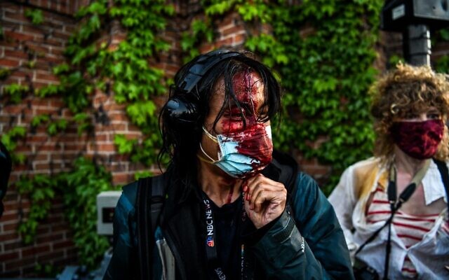 A journalist is seen bleeding after police started firing tear gas and rubber bullets near the 5th police precinct following a demonstration to call for justice for George Floyd, a black man who died while in custody of the Minneapolis police, on May 30, 2020 in Minneapolis, Minnesota (CHANDAN KHANNA / AFP) A journalist is seen bleeding after police started firing tear gas and rubber bullets near the 5th police precinct following a demonstration to call for justice for George Floyd, a black man who died while in custody of the Minneapolis police, on May 30, 2020 in Minneapolis, Minnesota (CHANDAN KHANNA / AFP)