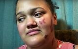 Althea Bernstein, who says she received burns to her face after being set alight by an attacker as she sat in her car in the US state of Wisconsin, on June 24, 2020. (Screen capture: YouTube)