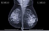 An illustrative image of a mammogram (Courtesy)