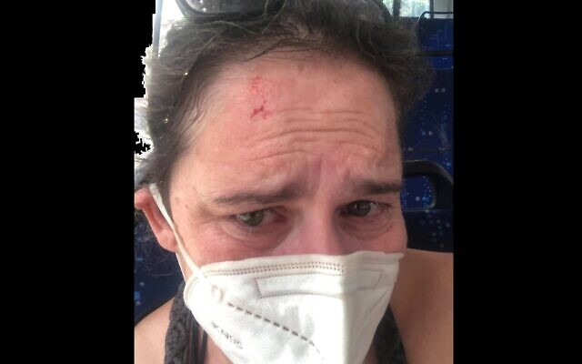 Sarah Nadav, shortly after being attacked on a Tel Aviv bus (via Sarah Nadav) Sarah Nadav, shortly after being attacked on a Tel Aviv bus (via Sarah Nadav)