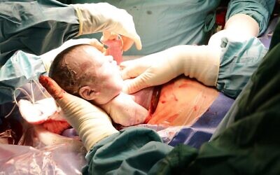 The baby born October 14, 2020, after an ex utero intrapartum procedure at Tel Aviv Sourasky Medical Center (courtesy of Tel Aviv Sourasky Medical Center)