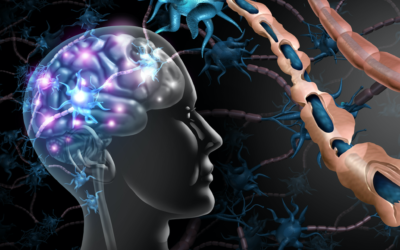 An illustration of the impact of multiple sclerosis on the brain. On the left, a brain with white areas denoting MS damage. On the upper right, close-up of regular myelin, and below, damaged myelin. (wildpixel via iStock by Getty Images)