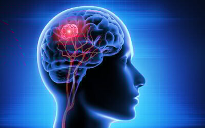 Illustration of a brain tumor caused by glioblastoma (peterschreiber.media via iStock by Getty Images)