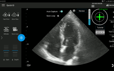 UltraSight, formerly On-Sight Medical, has developed AI-based ultrasound guidance technology for cardiac diagnosis (Courtesy)