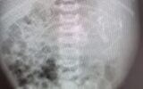 An X-ray showing the stomach of a newborn baby girl who was found to have an embryo inside her, July 2021. (Assuta Medical Center)
