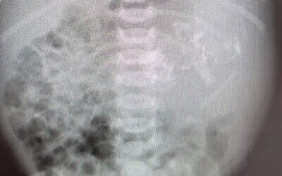 An X-ray showing the stomach of a newborn baby girl who was found to have an embryo inside her, July 2021. (Assuta Medical Center)