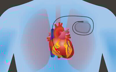Illustration of a pacemaker in the human body (chombosan via iStock by Getty Images)