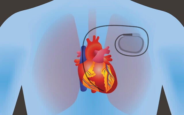 Illustration of a pacemaker in the human body (chombosan via iStock by Getty Images) Illustration of a pacemaker in the human body (chombosan via iStock by Getty Images)