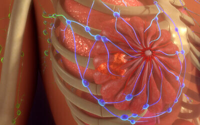 Illustration of metastasis, or metastatic disease, which is the spread of a cancer or other disease from one organ or part of the body to another not directly connected with it. (7activestudio  via iStock by Getty Images)