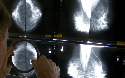 A radiologist uses a magnifying glass to check mammograms for breast cancer in Los Angeles, on May 6, 2010. (AP Photo/ Damian Dovarganes, File)