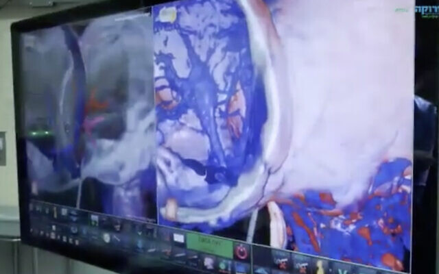 A screenshot from a video released by Soroka Medical Center on September 5, 2021, on a succesfull operation to separate twin girls conjoined at the head. (Screen capture: Facebook) A screenshot from a video released by Soroka Medical Center on September 5, 2021, on a succesfull operation to separate twin girls conjoined at the head. (Screen capture: Facebook)