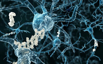 Illustrative: Amyloid plaques on neurons in a brain affected by Alzheimer's disease. (selvanegra via iStock)