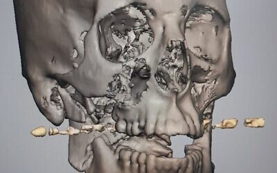 3D imaging of "Dalet's" jaw after injury, with the bullet shown. (Courtesy of Rambam Healthcare Campus)