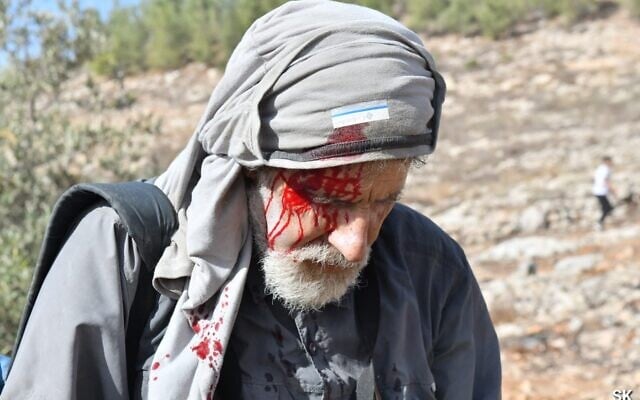 Left-wing activist Rabbi Arik Ascherman after an alleged attack by Israeli settlers near the West Bank settlement of Bat Ayin on Friday, November 12, 2021 (credit: Shai Kendler)