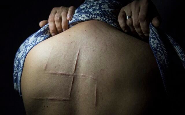 Illustrative: Bogdan Sergiets, former resident of Donetsk, shows a swastika scar on his back in a photographer's studio in Kyiv, Ukraine, October 9, 2019. (AP Photo/ Zoya Shu) Illustrative: Bogdan Sergiets, former resident of Donetsk, shows a swastika scar on his back in a photographer's studio in Kyiv, Ukraine, October 9, 2019. (AP Photo/ Zoya Shu)