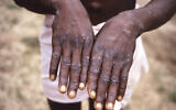 This 1997 image provided by the CDC  during an investigation into an outbreak of monkeypox, which took place in the Democratic Republic of the Congo (DRC), formerly Zaire, and depicts the dorsal surfaces of the hands of a monkeypox case patient, who was displaying the appearance of the characteristic rash during its recuperative stage. (CDC via AP)