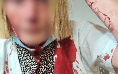 A photo released by the Health Ministry shows Dr. Idit Weisbach following an attack by a patient at a clinic in Beer Yaakov on June 14, 2022 (Health Ministry)