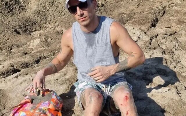 Lior Israelov with scrapes and burns after getting trapped in a sinkhole near the Dead Sea in July 2022. (Screenshot) Lior Israelov with scrapes and burns after getting trapped in a sinkhole near the Dead Sea in July 2022. (Screenshot)