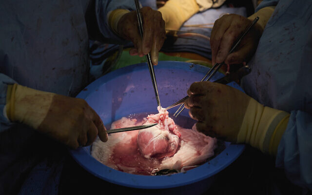 In this photo provided by NYU Langone Health, surgeons prepare a genetically modified pig heart for transplant into a recently deceased donor at NYU Langone Health on July 6, 2022, in New York (Joe Carrotta/NYU Langone Health via AP) In this photo provided by NYU Langone Health, surgeons prepare a genetically modified pig heart for transplant into a recently deceased donor at NYU Langone Health on July 6, 2022, in New York (Joe Carrotta/NYU Langone Health via AP)