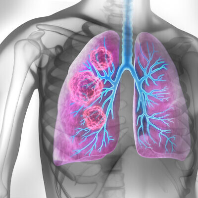 Medical Illustration of lung cancer, with a cancerous area in lungs (peterschreiber.media via iStock by Getty Images)