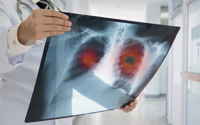 A doctor detects lung cancer on a scan (utah778 via iStock by Getty Images)