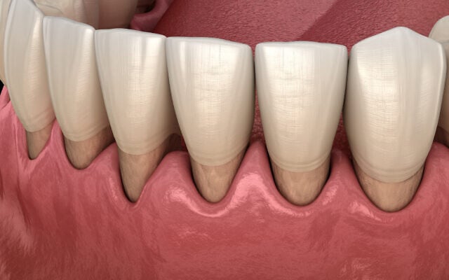 Illustrative image: gum recession in a human mouth. (alex-mit via iStock by Getty Images)