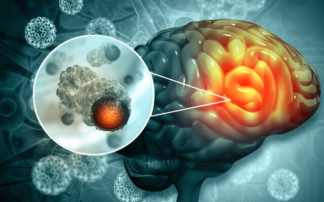 Illustrative: A human brain with a cancerous growth. (Mohammed Haneefa Nizamudeen; iStock by Getty Images) Illustrative: A human brain with a cancerous growth. (Mohammed Haneefa Nizamudeen; iStock by Getty Images)