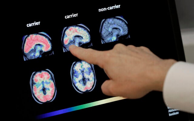 FILE - In this Aug. 14, 2018 file photo, a doctor looks at PET brain scans in Phoenix (AP Photo/Matt York, File) FILE - In this Aug. 14, 2018 file photo, a doctor looks at PET brain scans in Phoenix (AP Photo/Matt York, File)