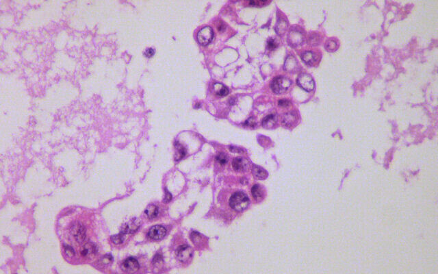 Illustrative: Metastatic ovarian adenocarcinoma- Pleural fluid cell block (Yale Rosen via Wikimedia Commons) Illustrative: Metastatic ovarian adenocarcinoma- Pleural fluid cell block (Yale Rosen via Wikimedia Commons)