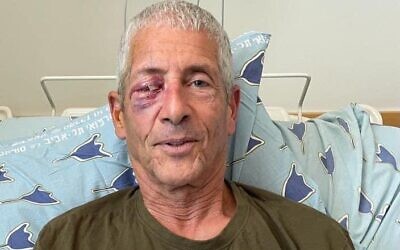 Brothers in Arms member Udi Ori at the hospital on July 7, 2023, after suffering an eye injury when taking a direct hit from a water cannon during a protest against the judicial overhaul in Tel Aviv on July 5, 2023. (Courtesy)