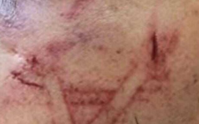 A photo released by police on August 19, 2023, shows cut marks on a Palestinian detainee's face that the force alleges was caused by an officers boot. A lawyer for the suspect alleges police branded him with a Star of David. (Israel Police) A photo released by police on August 19, 2023, shows cut marks on a Palestinian detainee's face that the force alleges was caused by an officers boot. A lawyer for the suspect alleges police branded him with a Star of David. (Israel Police)