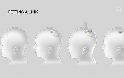 File: This video grab made from the online Neuralink livestream shows a drawing of the different steps of the implantation of a Neuralink brain implant device seen during a presentation on August 28, 2020. (Neuralink/AFP)
