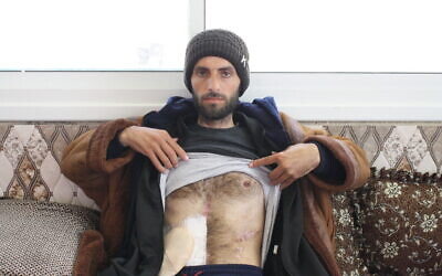 Zakaria al-Adra, who was shot and severely wounded by an Israeli settler in October 2023, shows his injuries in his home in the West Bank village of A-Tuwani, March 31, 2024. (Jeremy Sharon/Times of Israel)