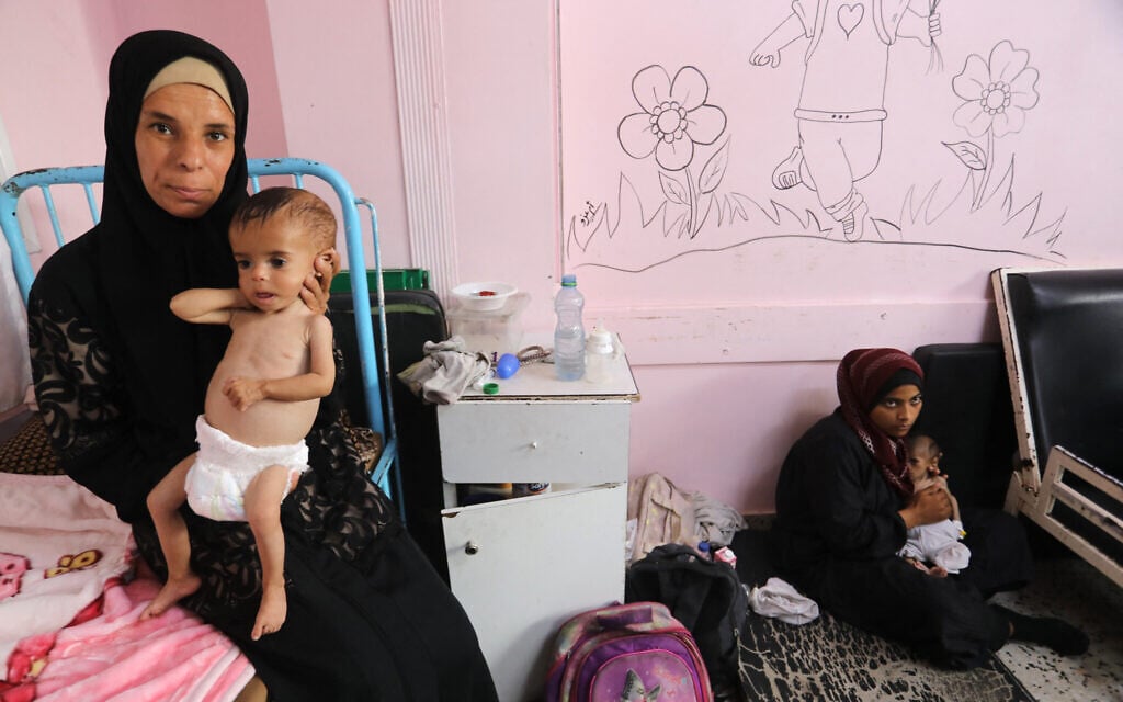 In one of Gaza’s few malnutrition wards, a child’s arm is as wide as her mother’s thumb