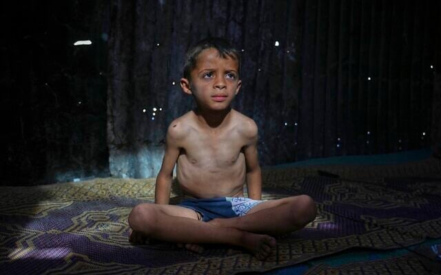 Ahmed El-Sheikh Eid, 7,  who shows signs of malnutrition, poses for a photo at his family tent at a camp for displaced Palestinians in Mawasi Khan Younis, Gaza Strip, Friday, May 2, 2025. (AP Photo/Abdel Kareem Hana)